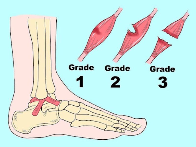 Phương pháp an toàn và hiệu quả để điều trị khi bị lật cổ chân
